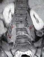 CASE REPORT:  A RARE CASE OF EXTRANODAL NON-HODGKIN’S LYMPHOMA