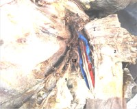 An anomalous muscular belly in the axillary region– A case report