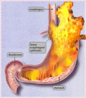CONCEPT OF AGNI IN AYURVEDA